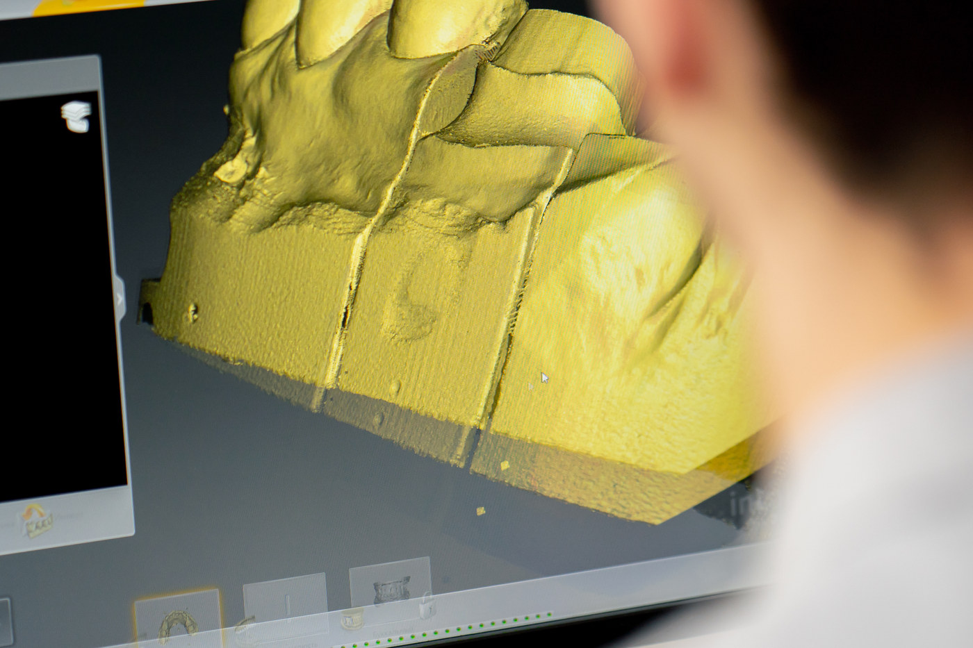 Digitales Zahnmodell auf dem Bildschirm für die CAD/CAM-Bearbeitung